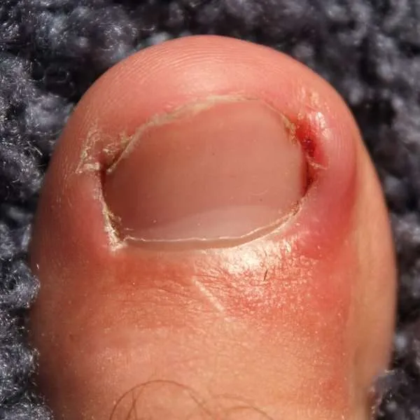 Ingrown toenail lateral nail edge