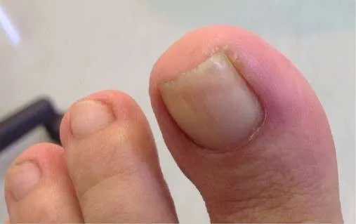 Ingrown Toenail Treatment | Options and Cost | The Foot Hub
