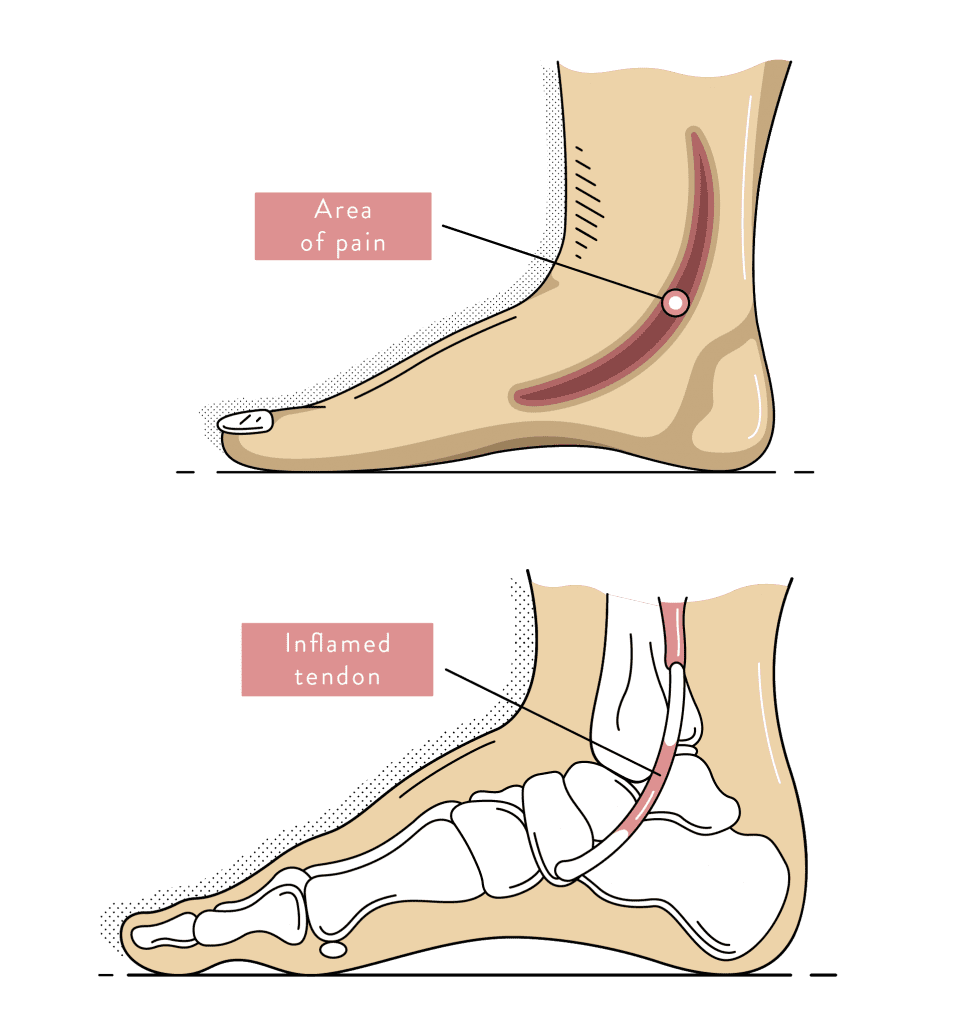 Pain in ankle and heel discount