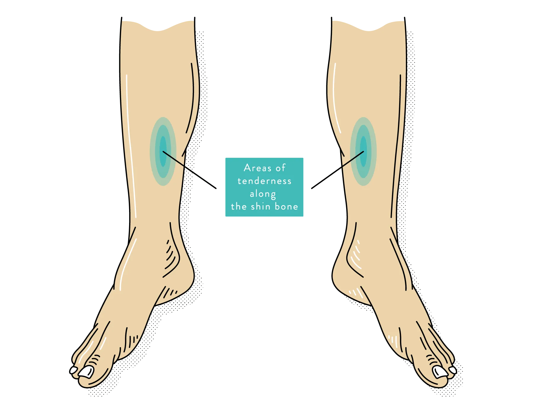Shin Splints: Symptoms, Causes & Treatments
