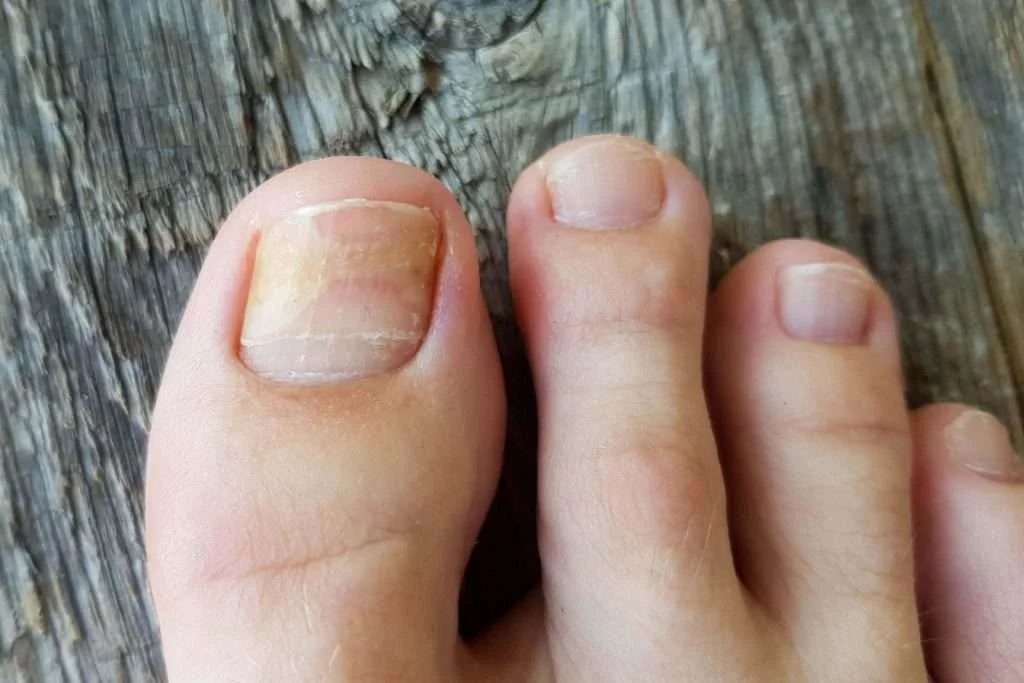 A DARK LINE UNDER YOUR TOENAIL COULD INDICATE CANCER STATES PODIATRIST