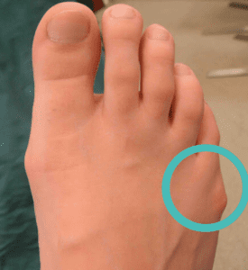 bunion on pinky