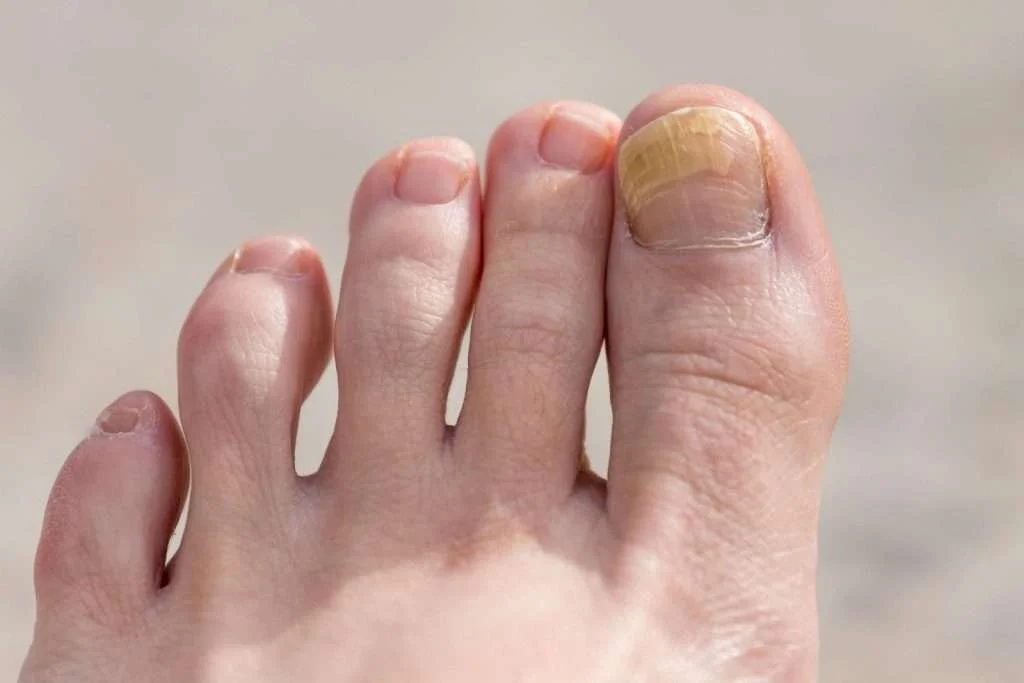 Common Nail Conditions | Diagnosis and Treatment Options