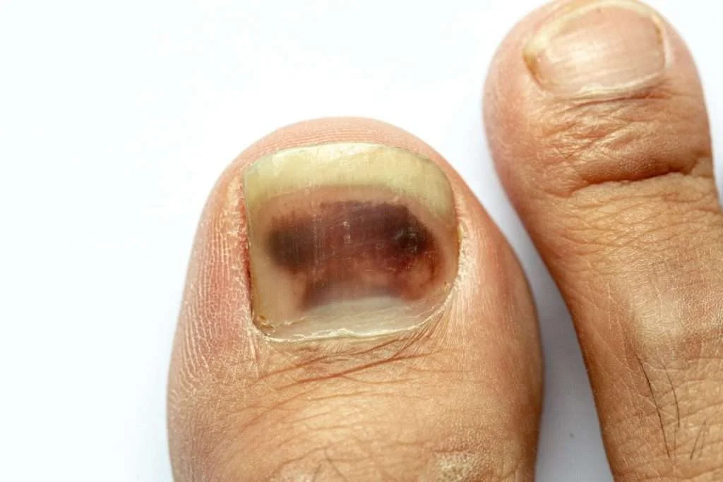 Bruising under toenail