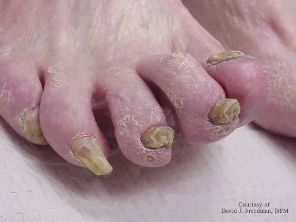 thickened toenails
