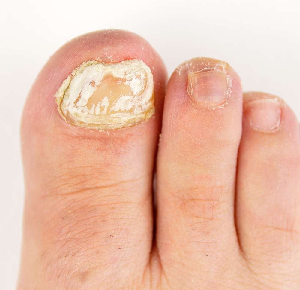 superficial white onychomycosis
