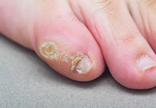 Symptoms and Treatment for Corns and Calluses