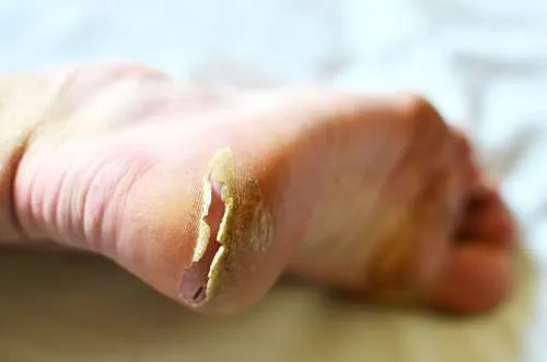 Heel Fissure A heel fissure is... - Rovon Foot Clinic | Facebook